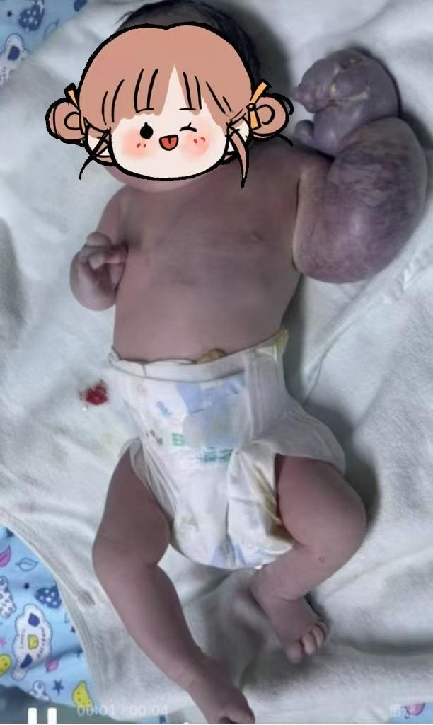 新生儿天生左臂“麒麟臂”险坏死！多学科专家成功为娃保肢